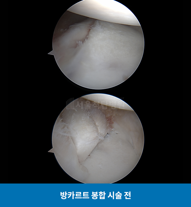 방카르트 봉합 시술 전