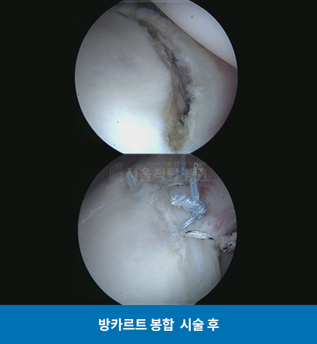 방카르트 봉합 시술 후