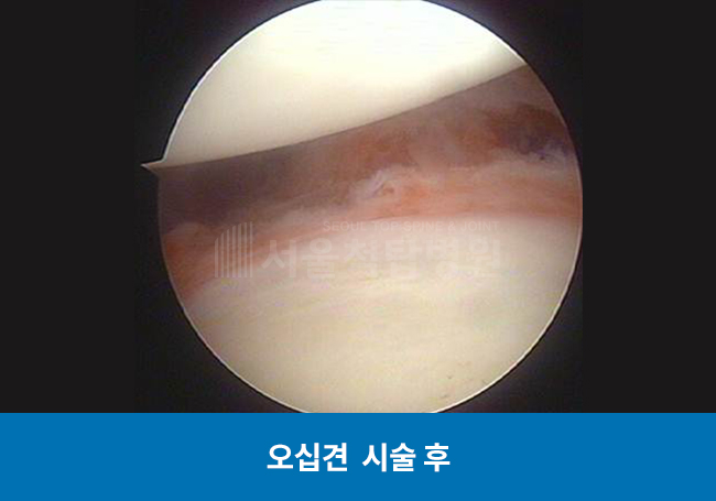 오십견 시술 후