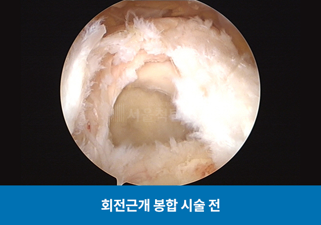 회전근개 봉합 시술 전