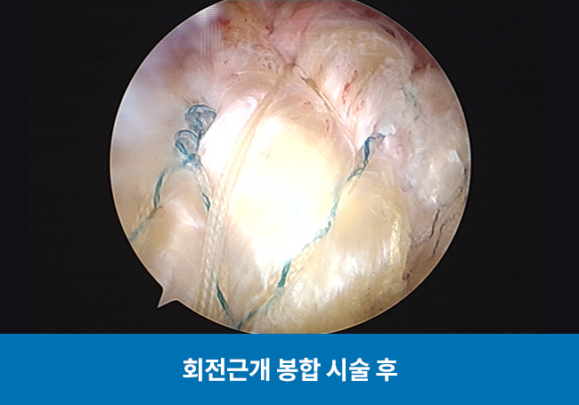 회전근개 봉합 시술 후