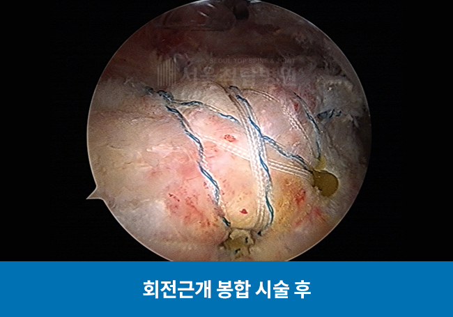 회전근개 봉합 시술 후