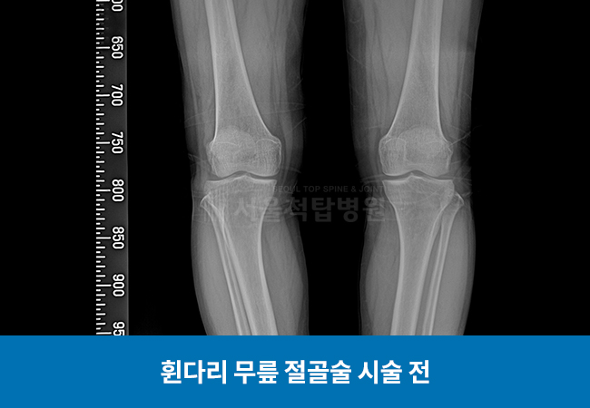 휜다리 무릎 절골술 시술 전