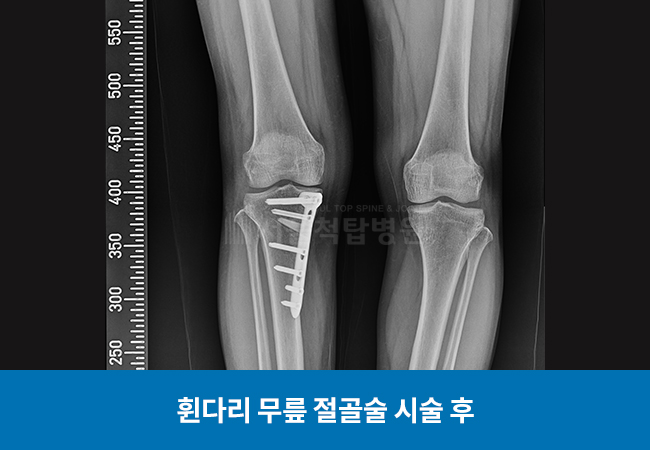 휜다리 무릎 절골술 시술 후