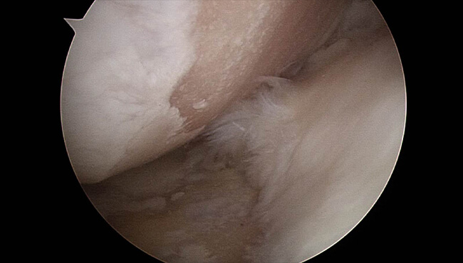 줄기세포 관절경 시술 전