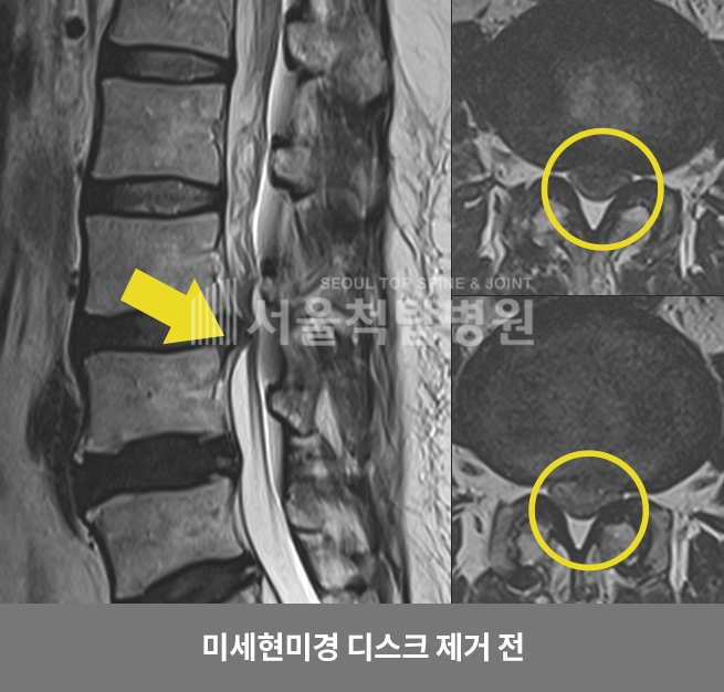 미세현미경 디스크 제거 전