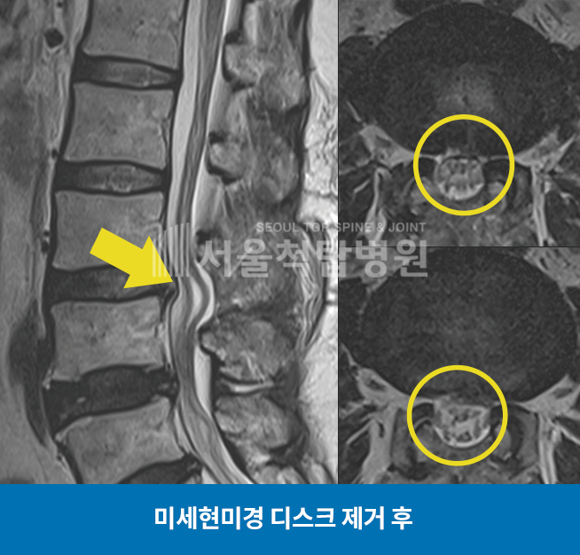 미세현미경 디스크 제거 후