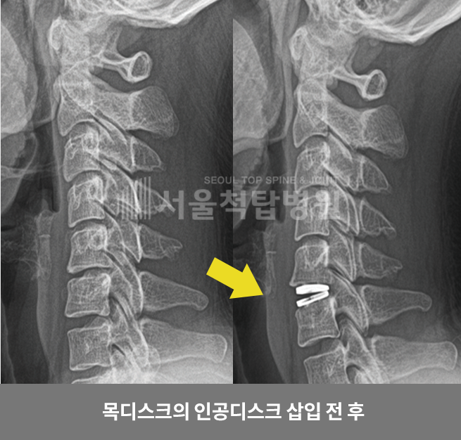 목디스크의 인공디스크 삽입 전/후