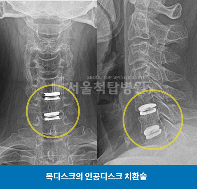 목디스크의 인공디스크 치환술