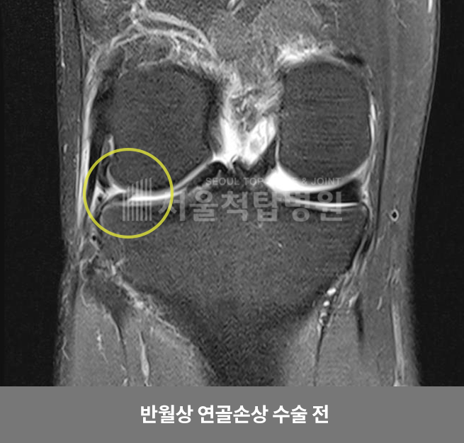 반월상 연골손상 수술 전