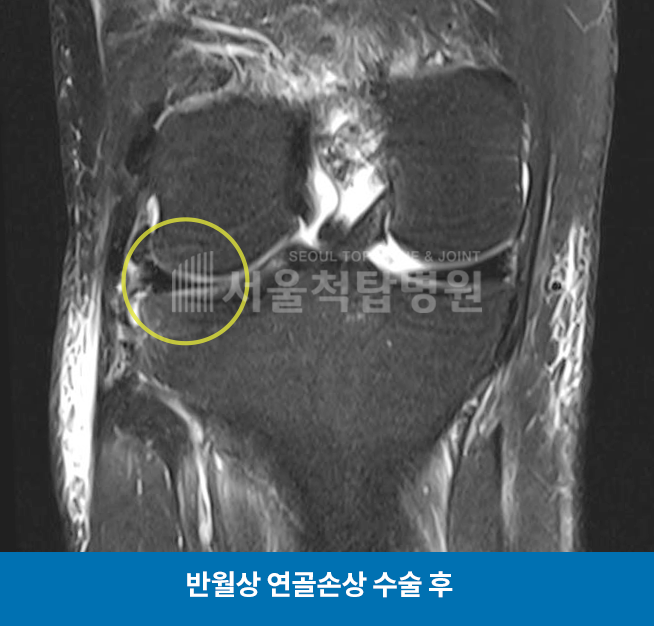 반월상 연골손상 수술 후