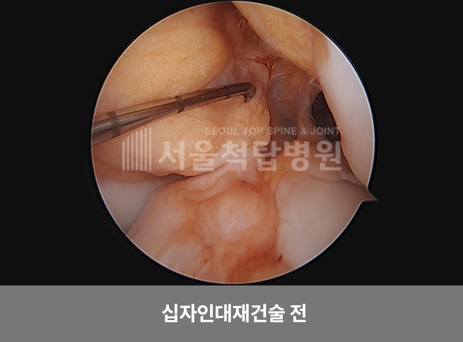 십자인대재건술 전