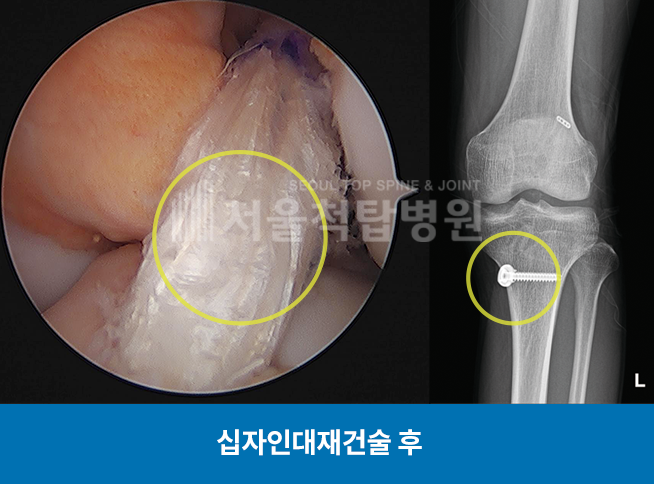 십자인대재건술 후