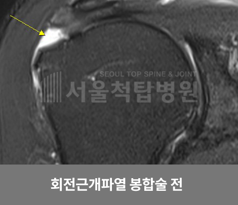 회전근개파열 봉합술 전