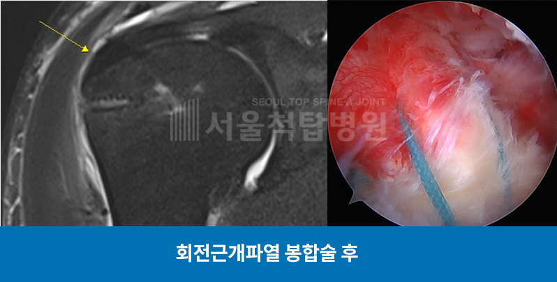 회전근개파열 봉합술 후