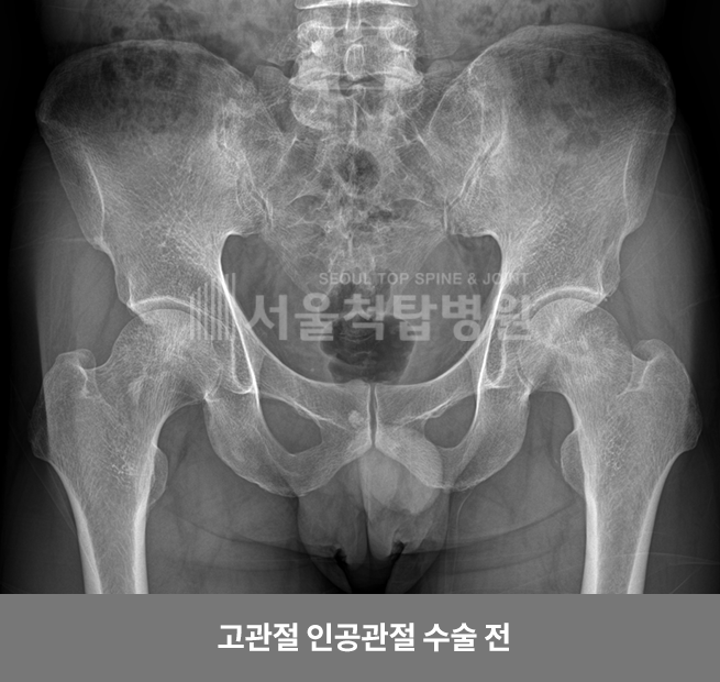 고관절 인공관절 수술 전