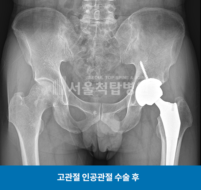 고관절 인공관절 수술 후