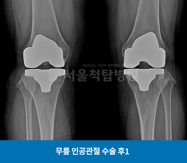 무릎 인공관절 수술 후1