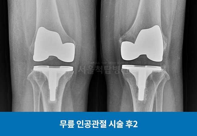 무릎 인공관절 수술 후2