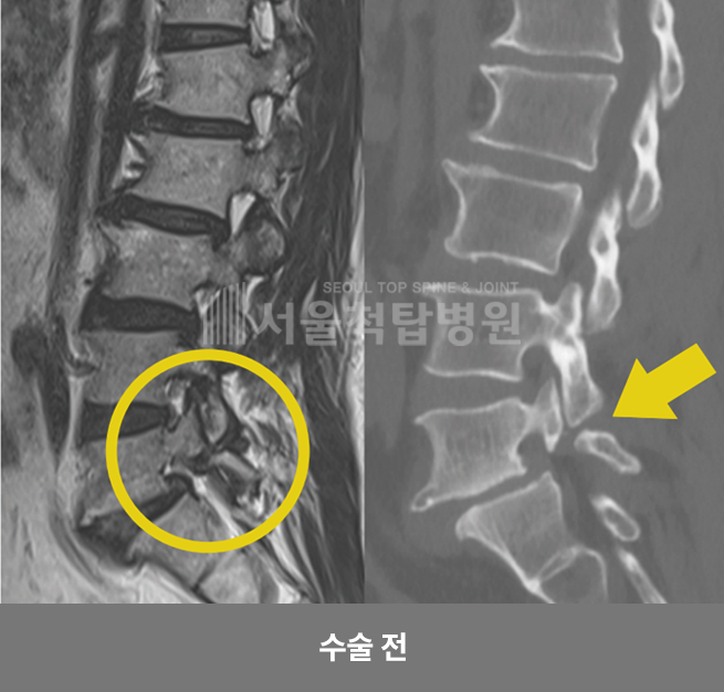 척추유합술 수술전