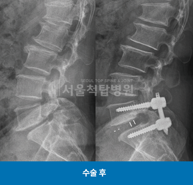 척추유합술 수술후